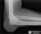 olecranon bursitis, gout